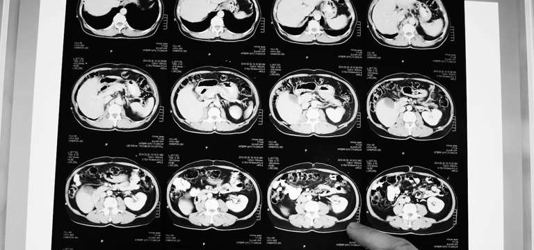 MRI Brain Test: A Guide to Neurological Health